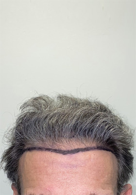 hair transplant photos