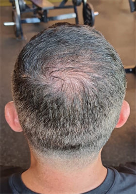 hair transplant before after Photos