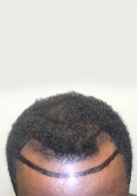 hair transplant photos