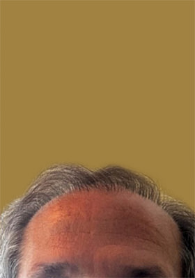 hair transplant photos