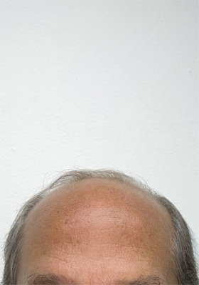 hair transplant photos