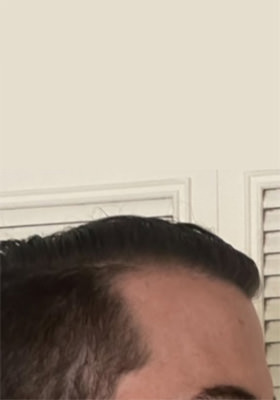 hair transplant photos