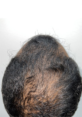 hair transplant before after Photos