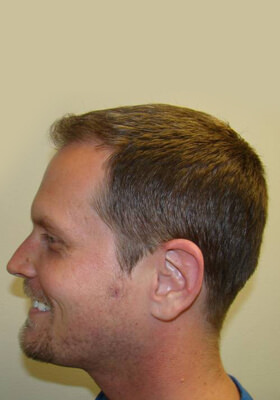 hair transplant photos