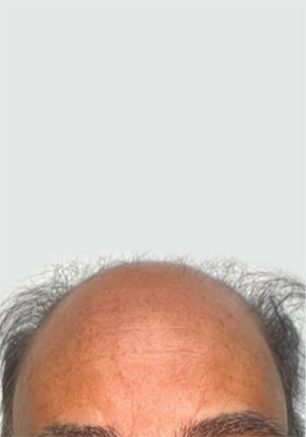 hair transplant before after Photos