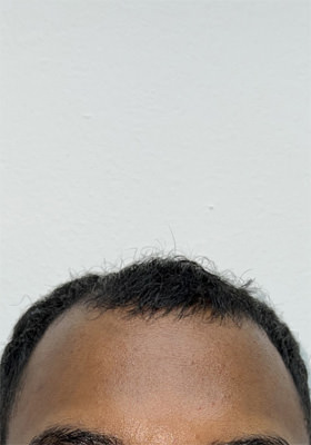 hair transplant photos