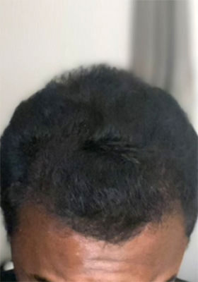 hair transplant photos