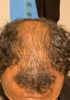 hair transplant photos