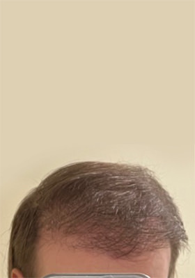 hair transplant photos