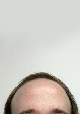 hair transplant photos