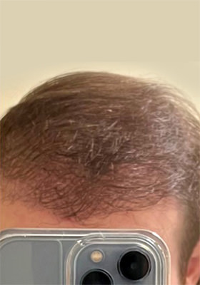 hair transplant photos