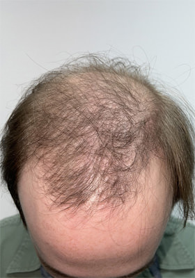 hair transplant photos