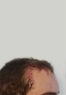 hair transplant photos