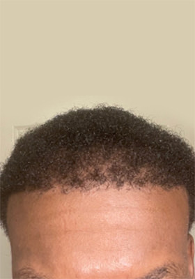 hair transplant photos