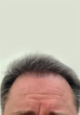 hair transplant photos