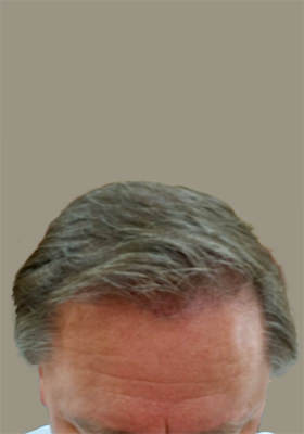 hair transplant photos