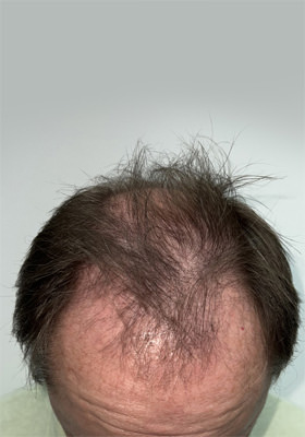 hair transplant photos