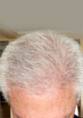 hair transplant photos