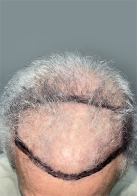 hair transplant photos