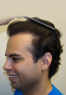 hair transplant photos