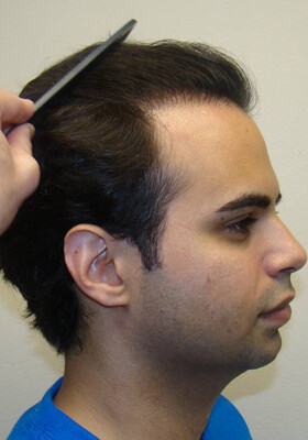 hair transplant photos