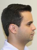 hair transplant photos