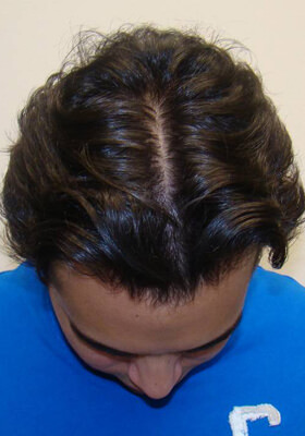 hair transplant photos