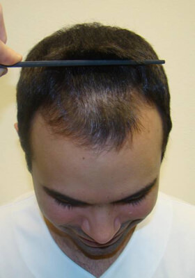 hair transplant photos