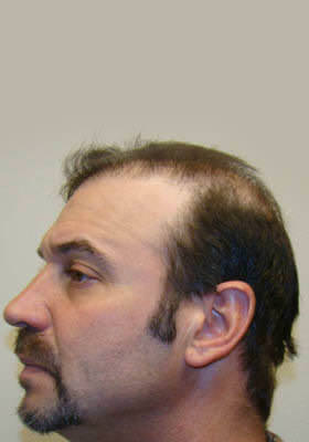 hair transplant before after Photos