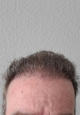 hair transplant before after Photos