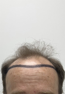 hair transplant photos