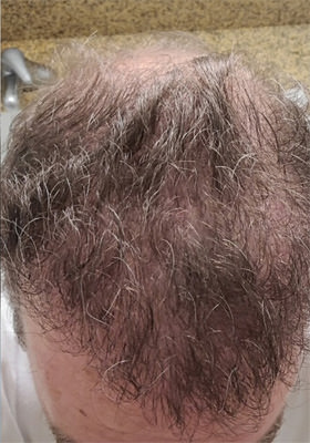 hair transplant photos