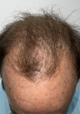 hair transplant before after Photos