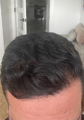 hair transplant photos