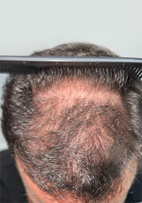 hair transplant photos