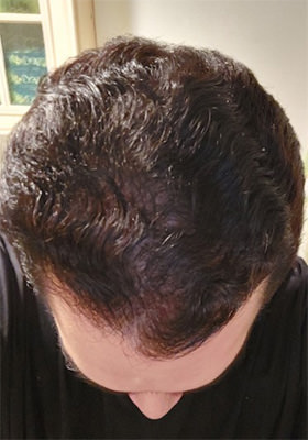 hair transplant before after Photos