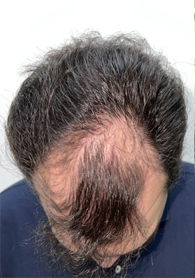 hair transplant photos