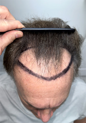 hair transplant photos