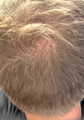 hair transplant before after Photos