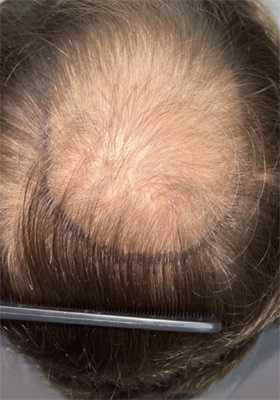 hair transplant before after Photos