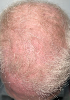 hair transplant photos