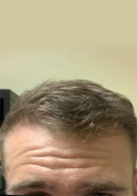 hair transplant before after Photos