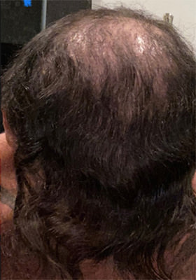 hair transplant before after Photos