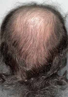 hair transplant photos