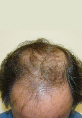 hair transplant before after Photos