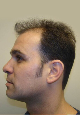 hair transplant photos