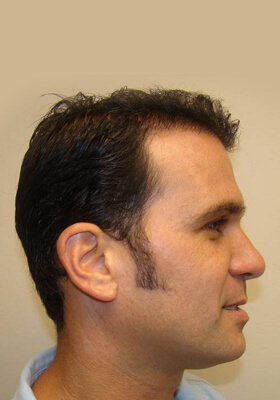 hair transplant photos