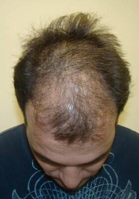 hair transplant photos