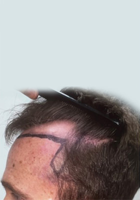 hair transplant before after Photos