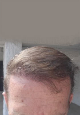 hair transplant before after Photos